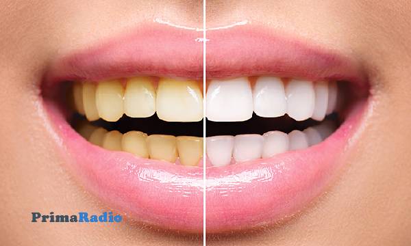 7 Bahaya dan Risiko Bleaching Gigi yang Perlu Diperhatikan