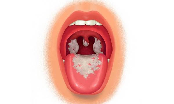 Difteri penyakit menular oleh bakteri Corynebacterium diphtheriae